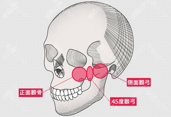 颧骨内推手术