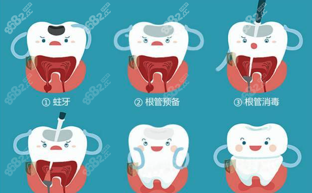 深龋做根管治疗会比较好
