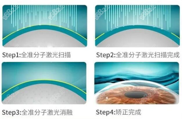 深圳飞秒激光近视手术价格多少钱