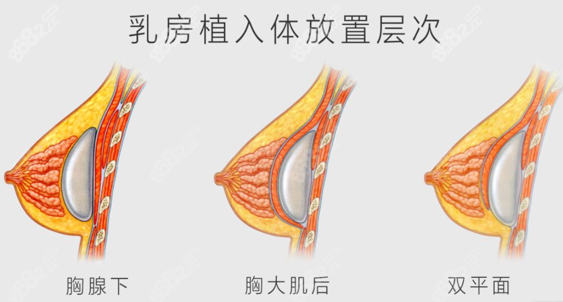 假体隆胸手术示意图8682.cc