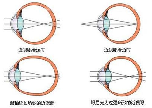 北京希玛林顺潮眼科医院近视眼手术价格