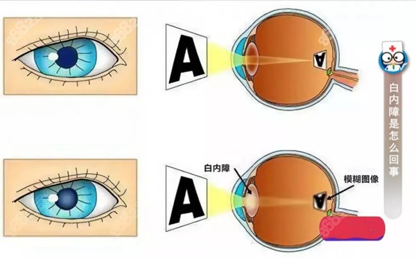 北京希玛林顺潮眼科医院白内障手术费用8682.cc/