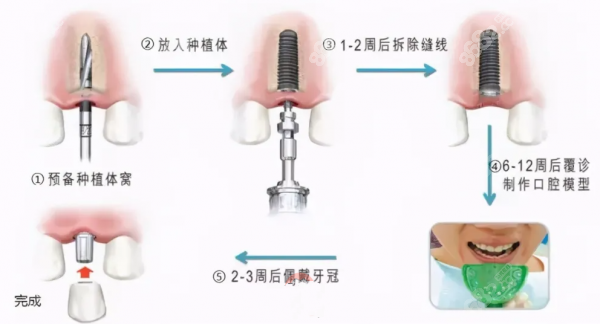 北京公家口腔医院种植牙多少一颗8682.cc