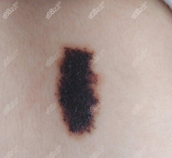 胎记可以去除掉吗？