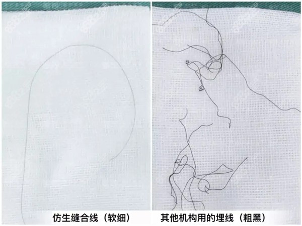 徐敦醫(yī)生做內(nèi)眼角回包縫合線比較細(xì)