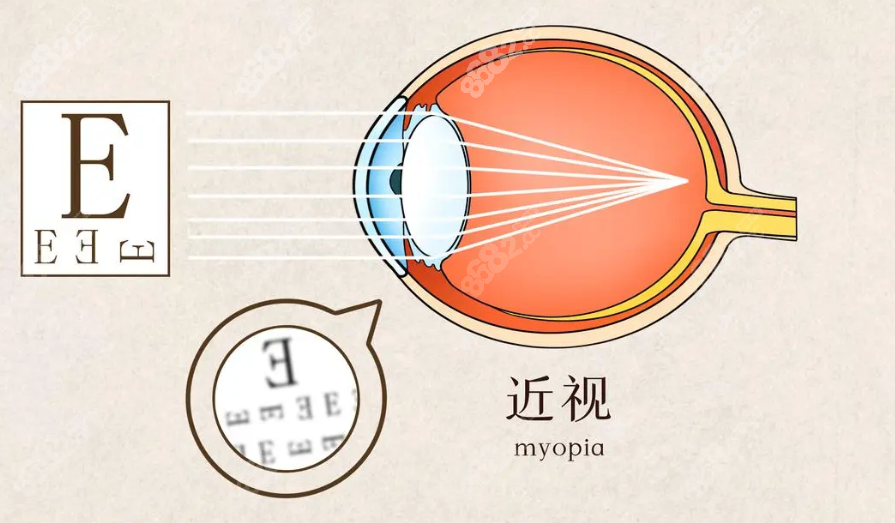 西安海翔眼科医院全激光近视手术价格11800-14800元不等