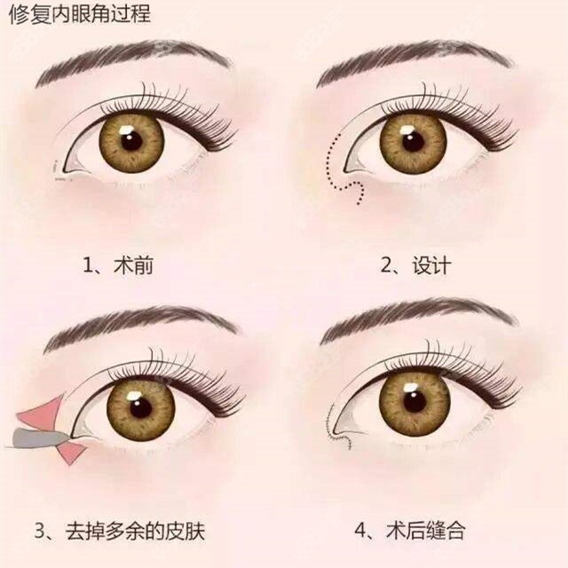 師麗麗醫(yī)生做眼角修復(fù)的方式不同www.sorencai.cn