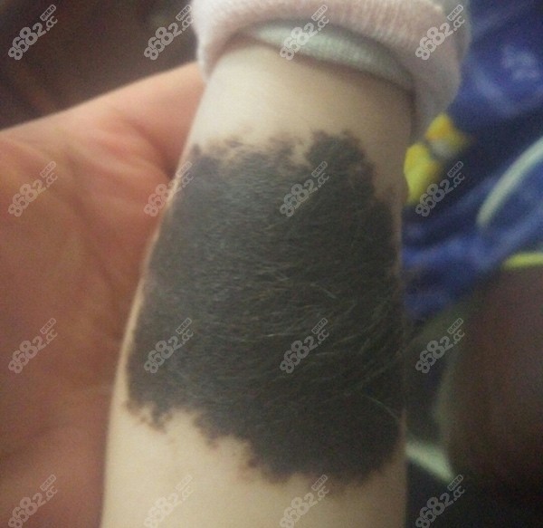 胎记去除有效的方法