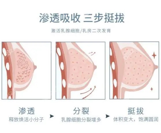 注射隆胸