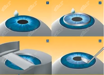 准分子激光手术是什么意思呢