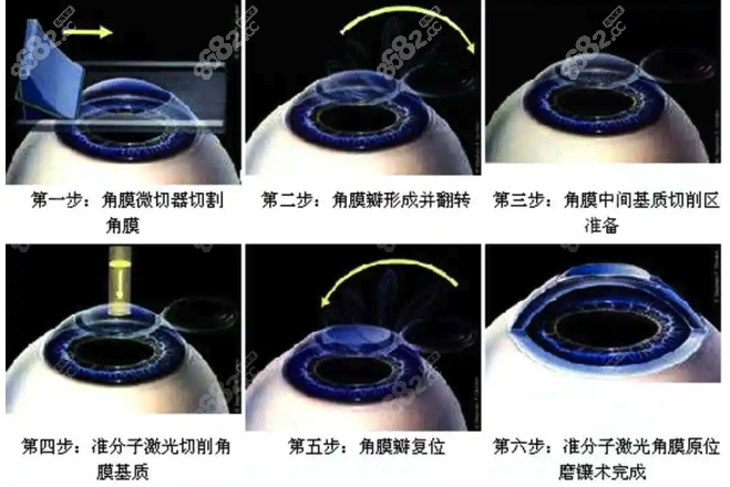 准分子激光手术到底有没有后遗症呢