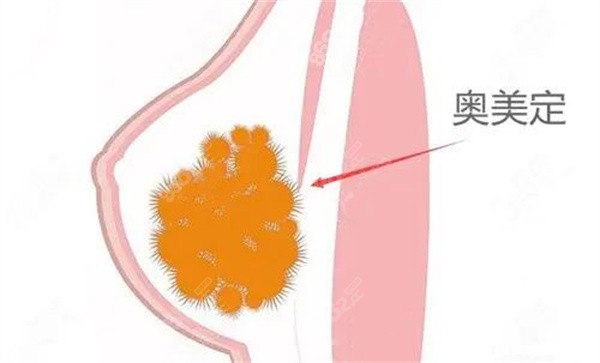 奥美定取出