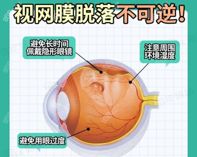 如何避免视网膜脱落