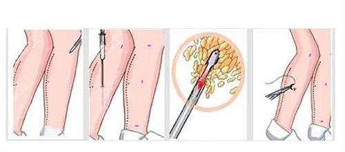 小腿吸脂后多久恢复正常