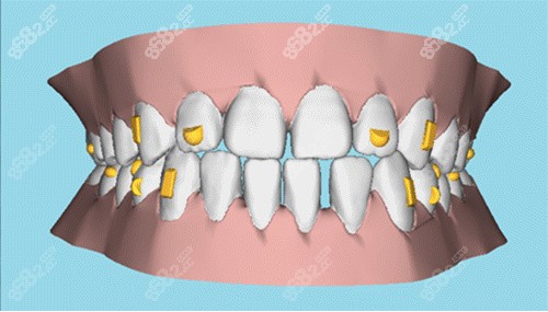 牙齿矫正图