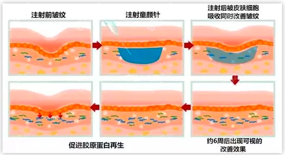 面部打艾维岚除皱疗效好