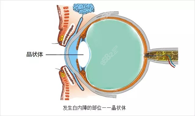 大连华厦眼科医院周明医生做白内障治疗好