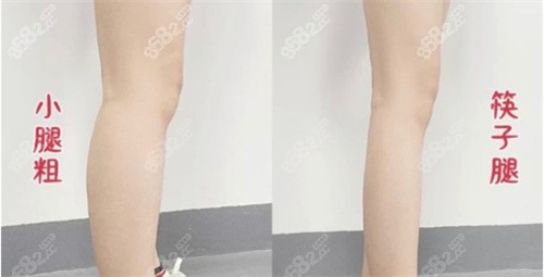 小腿吸脂多久能看到明显改善
