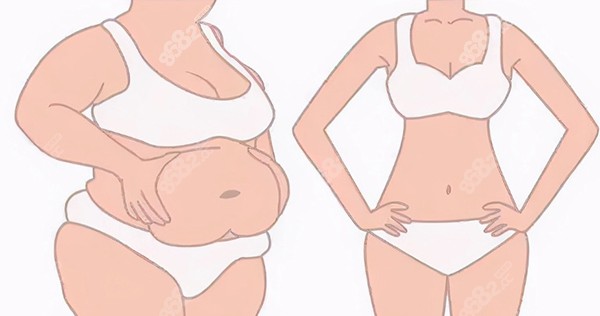 北京联合丽格吸脂怎么样？冯庆亮院长做吸脂评价很不错