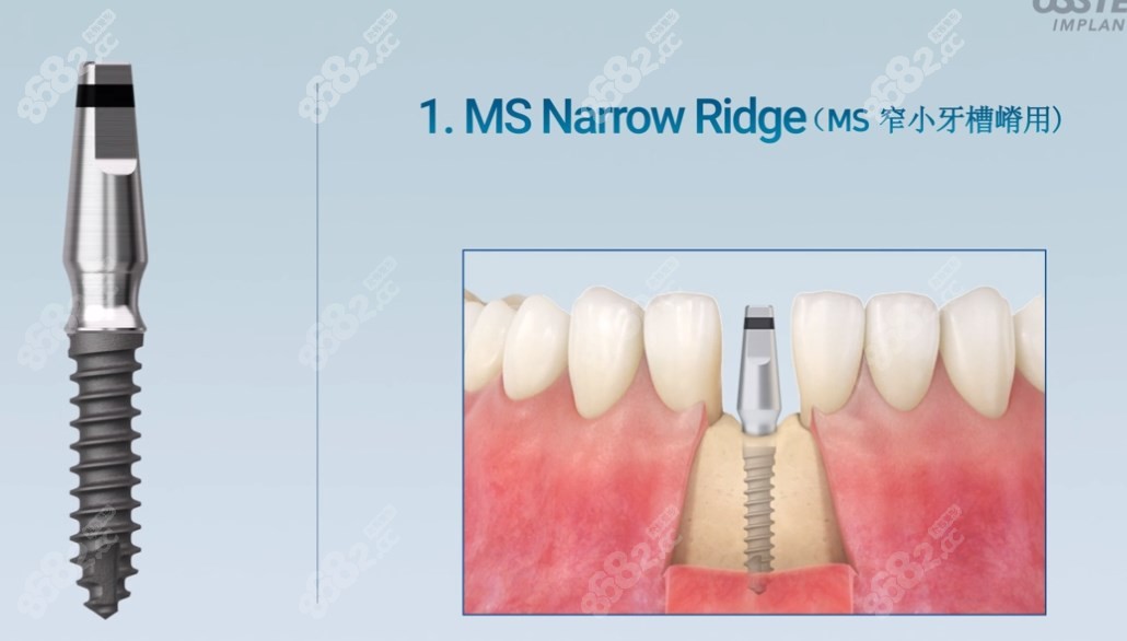 韩国奥齿泰种植体适应症