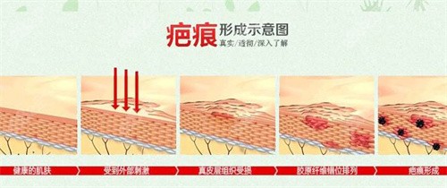 疤痕形成過程示意圖