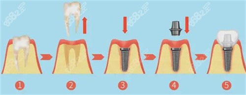 种植牙过程图