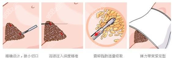 拉蒂安医院做腰腹吸脂技术好费用不贵www.8682.cc