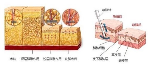 拉蒂安整形做吸脂手术的优势点