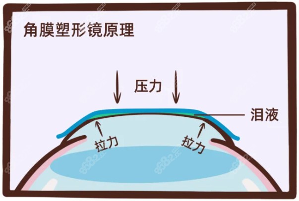 菁视角膜塑形镜原理