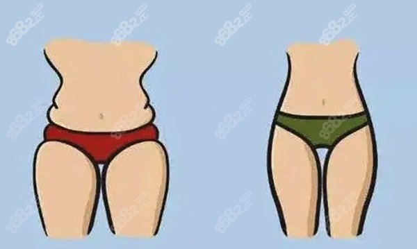 北京联合丽格吸脂怎么样？冯庆亮院长做吸脂评价很不错