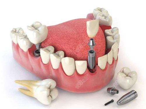 种植牙模型图示