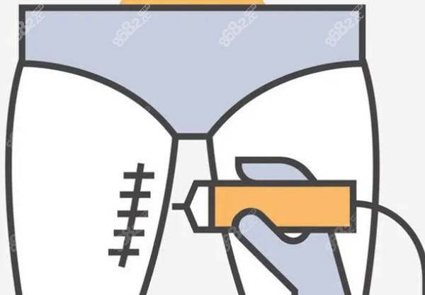 北京联合丽格吸脂怎么样？冯庆亮院长做吸脂评价很不错