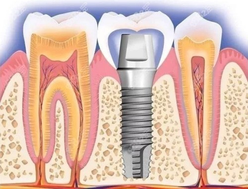 种植牙原理演示图