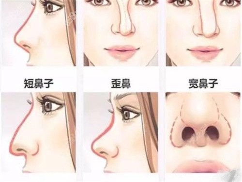成都后美整形医院肋软骨隆鼻优势有哪些？