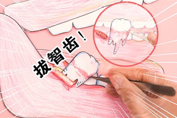 成都八大处口腔科补牙、拔牙、拔智齿、根管治疗、洗牙费用明细