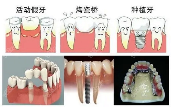 石家桥西区镶牙价格表8682.cc