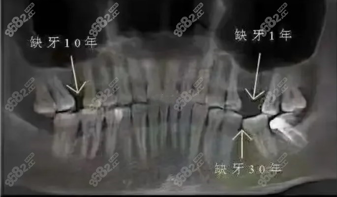 缺牙长时间不种植