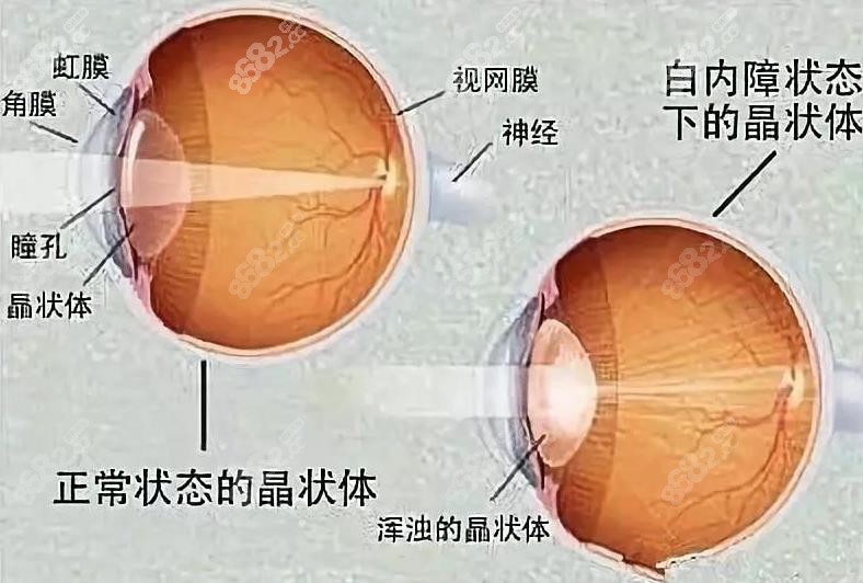 潍坊明润眼科医院做白内障治疗手术好