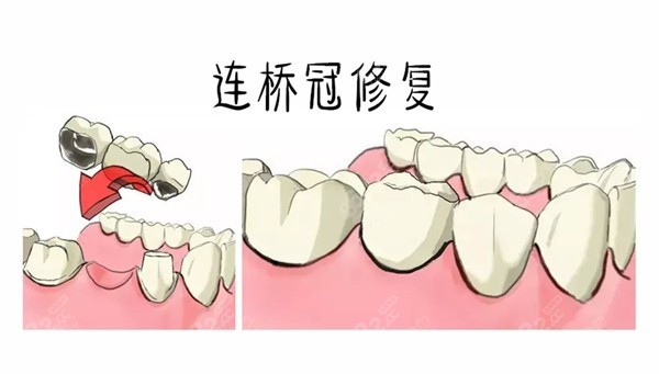 石家桥西区镶烤/全瓷牙收费标准