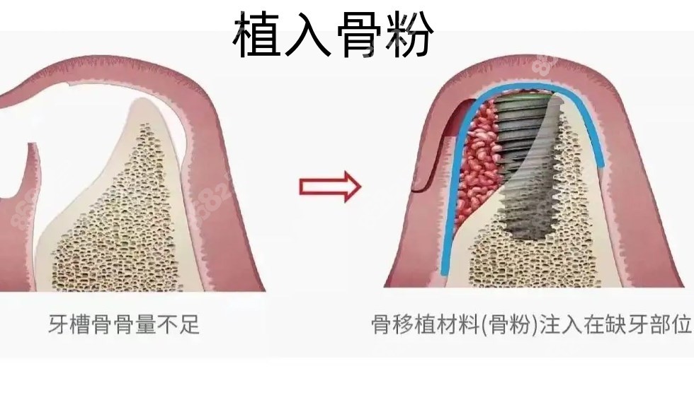 植入骨粉