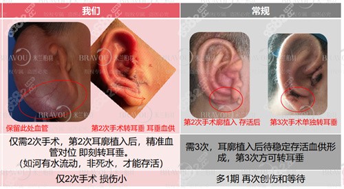 成都米兰柏羽医院小耳再造创口少