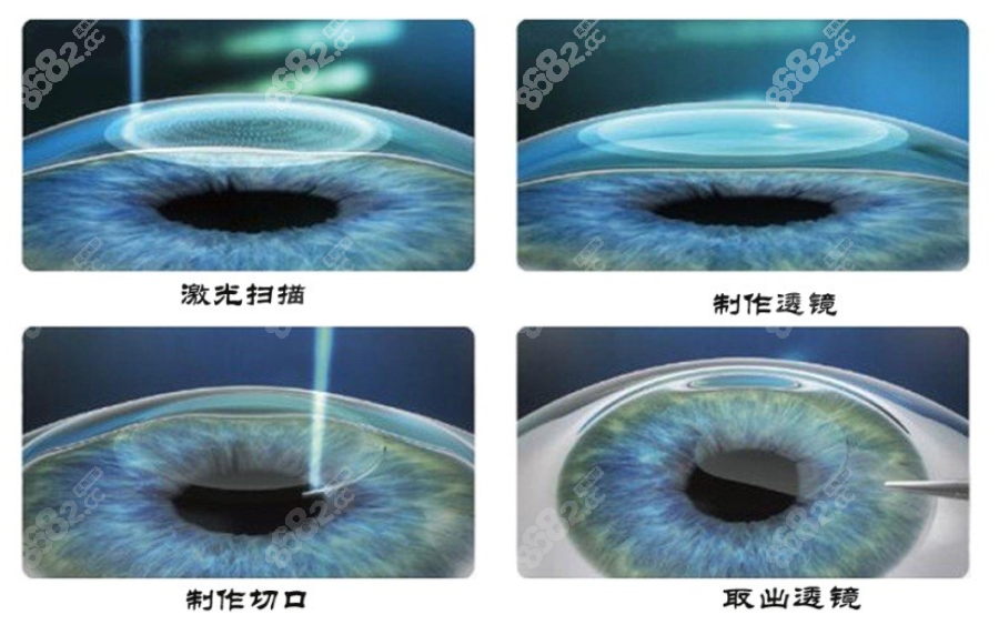 全飞秒激光手术8682.cc