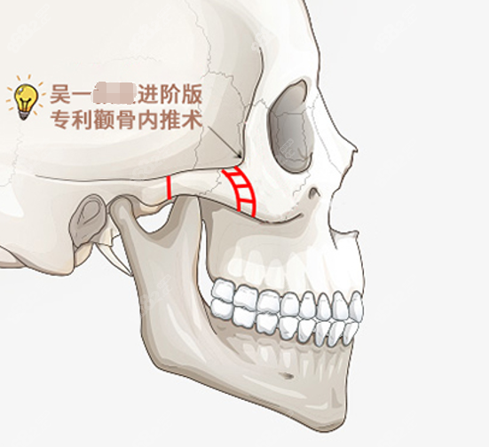 吴一磨骨手术前后真实图片