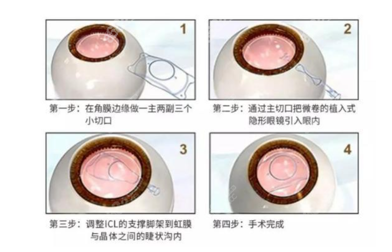 ICL晶体植入手术