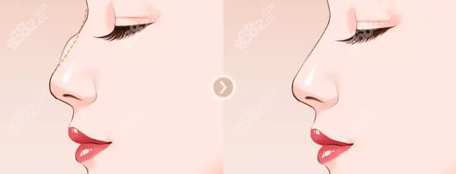 驼峰鼻矫正手术方法www.8682.cc