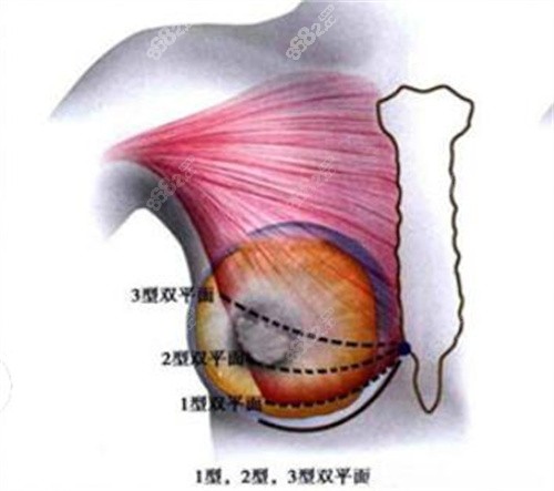 李<!--<i data=20240705-sp></i>-->双平面隆胸示意图