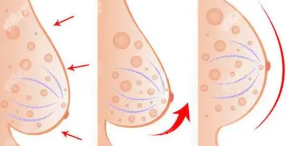 乳房下垂矫正