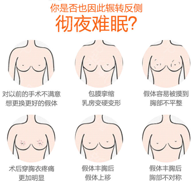隆胸修复8682.cc