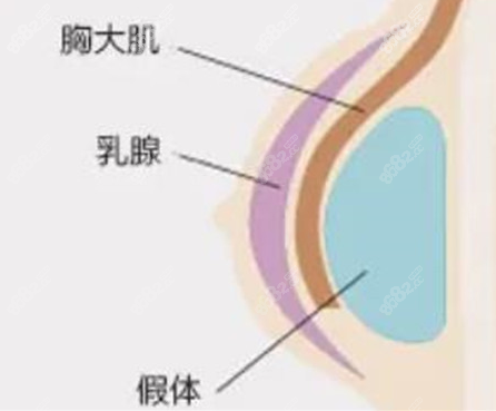 成都艺星韩春医生隆胸技术优势