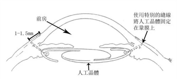 人工晶体植入